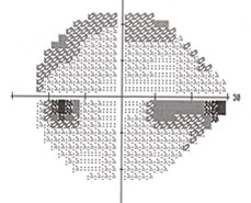 Glaucoma Treatment