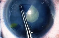 Cataract Surgery Honolulu, HI