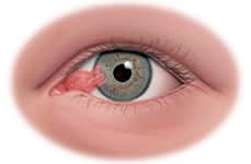 Pterygium Treatment Honolulu, HI | Pterygium Surgery Honolulu, HI