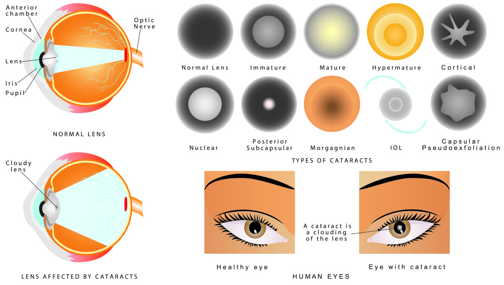 Types of Cataracts Honolulu, HI