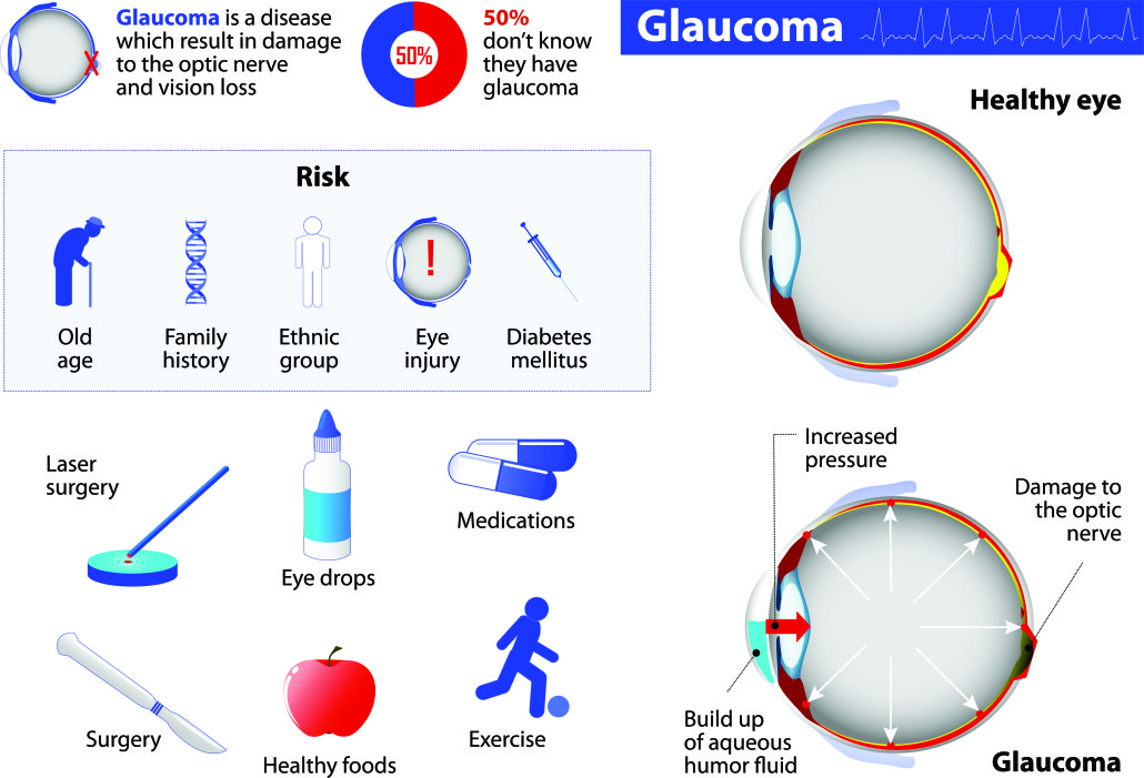 Glaucoma infographic featuring prevalence, risks factors, and treatment options