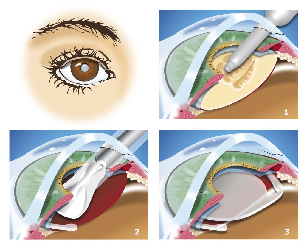 Diagram of the cataract surgery process, showing how the old lens of the eye is removed and a new lens is inserted.