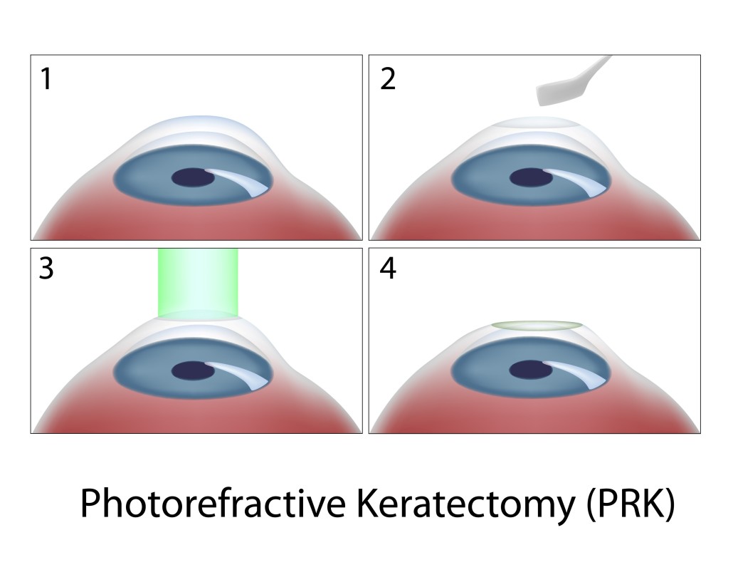 photo refractive keratectomy