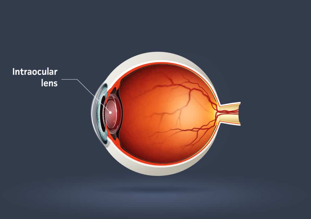 High qualirt raster illustration of intraocular lens