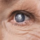 Cataract surgery