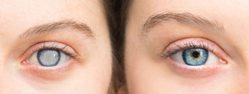 Woman with cataracts in Honolulu, HI