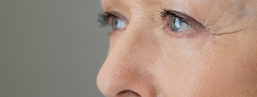 Close up of a older woman in need of Xeomin to tighten the skin around her eyes