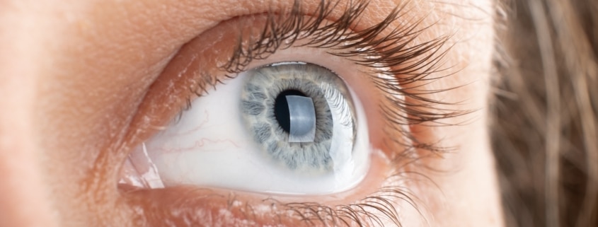 Close up of a patient's cornea fully healed after receiving a corneal transplant