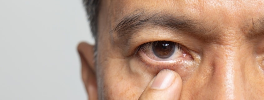 Close up of an elderly man touching his eye after experiencing blepharospasm, or excessive eye twitching.