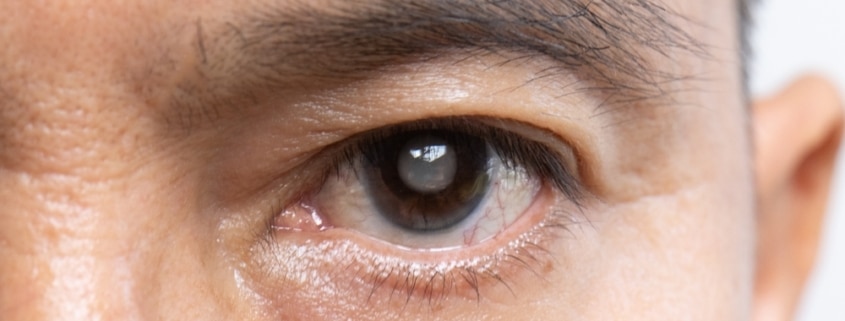 Close up of an older patient's eye with the fogginess of glaucoma starting to take over.