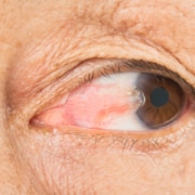 Close-up of an older woman suffering from a pterygium growing in her eye and affecting her vision.