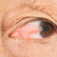 Close-up of an older woman suffering from a pterygium growing in her eye and affecting her vision.