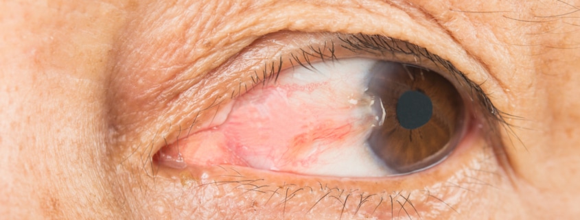 Close-up of an older woman suffering from a pterygium growing in her eye and affecting her vision.